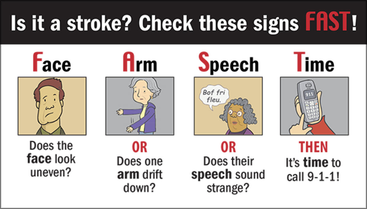 Stroke me. Stroke face. Signs of a stroke. The consequences of a stroke. Arm Drift stroke.